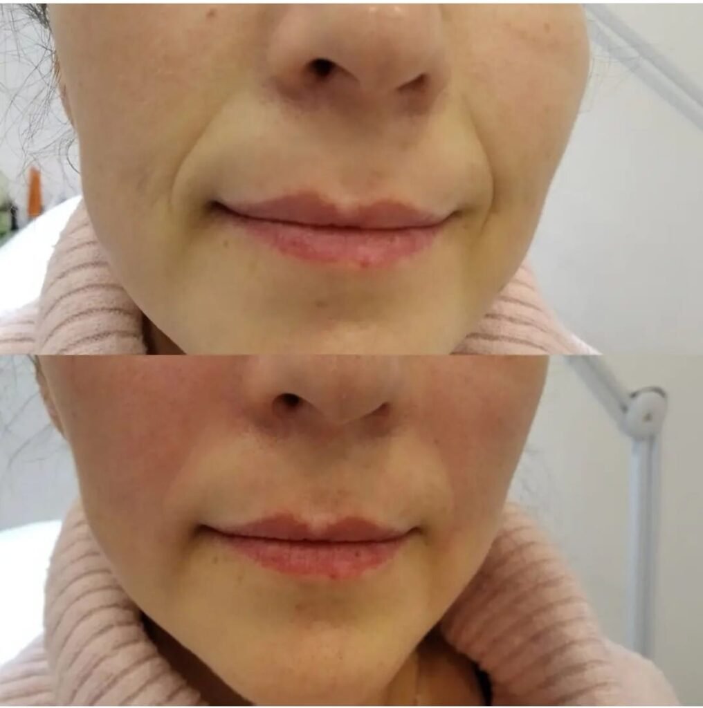 resultados sorprendentes del microneedling